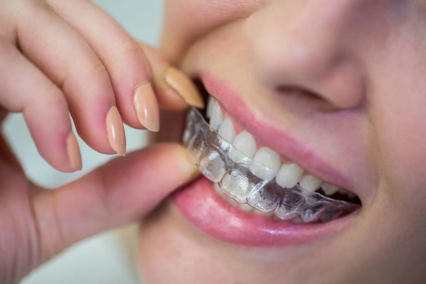 Paciente colocando alinhador invisível nos dentes